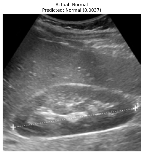 Kidney Stone Prediction