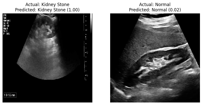 Kidney Stone Detection using Deep Learning